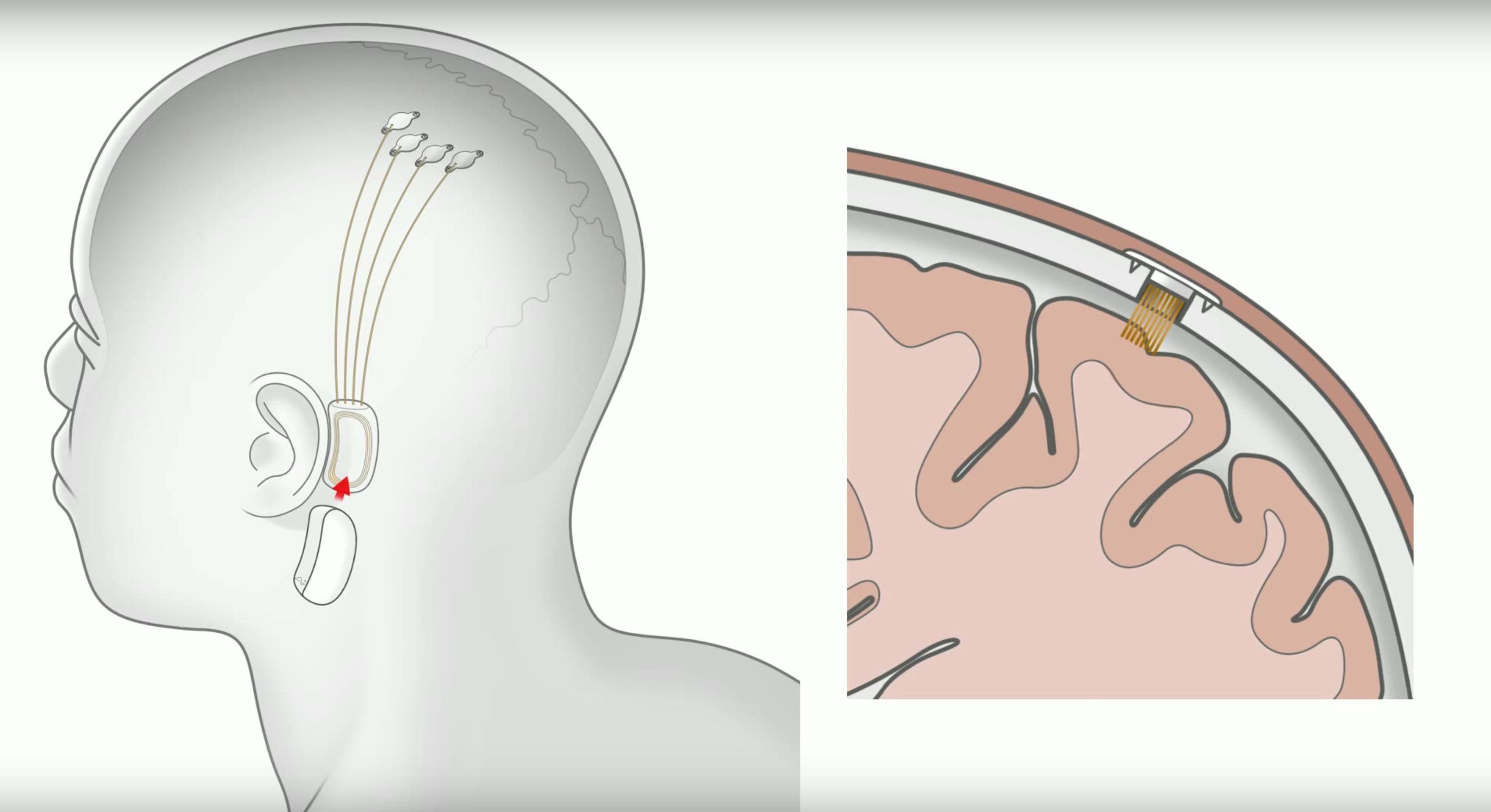 Schéma d'un implant Neuralink. © Neuralink