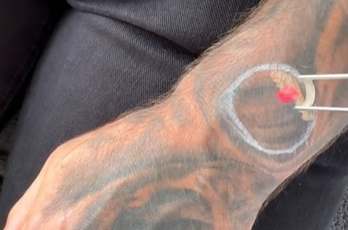 Un client se faire retirer un tatouage au niveau du poignet pour que son Apple Watch puisse fonctionner normalement. © @hwclinicbrugge