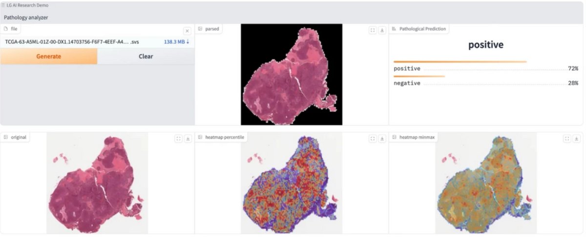 Les images histopathologiques peuvent être analysées et visualisées avec EXAONEPath pour identifier d'éventuelles altérations génétiques au sein des cellules. Les variations de couleur peuvent fournir des indices importants sur d'éventuelles altérations ou anomalies génétiques dans les cellules. Crédit image : LG AI Research © AWS / LG AI Research