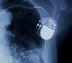 USA : 500 000 pacemakers vulnérables aux cyberattaques 