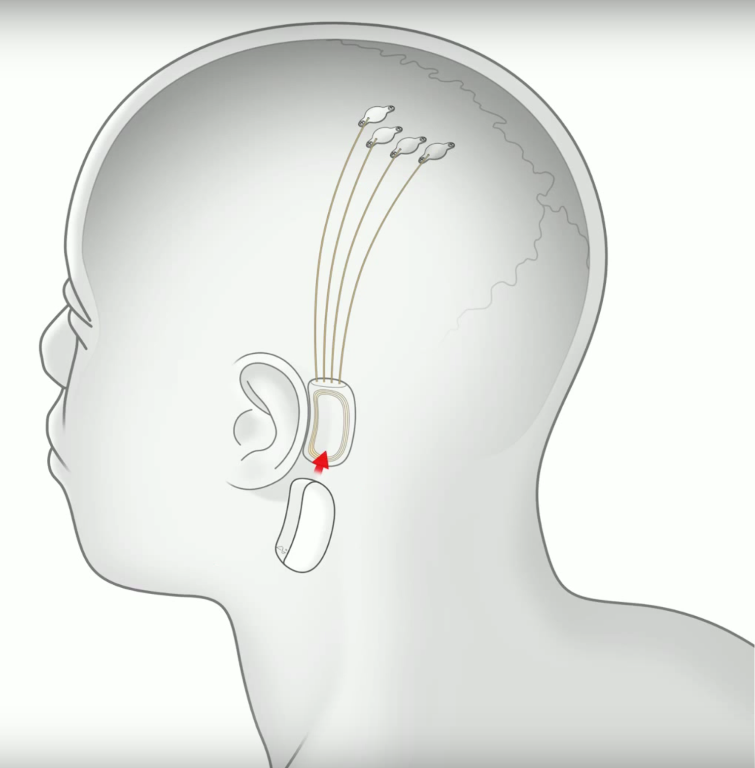 Neuralink : des avancées sur le projet de lien cerveau-ordinateur d'Elon Musk annoncées à la fin de l'été