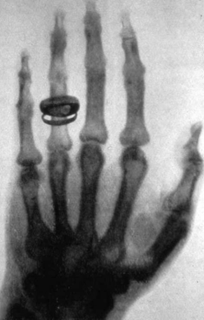 Un des premiers clichés radiographique pris par Wilhelm Röntgen