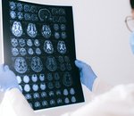 Alzheimer : des chercheurs développent un test qui pourrait révolutionner la détection de la maladie